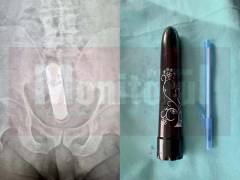 Un sucevean plecat în ospeție la o botoșăneancă a ajuns la spital cu un vibrator în fund
