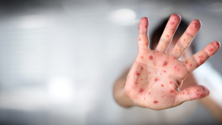 Focar de rujeolă la Bogata. Doar 9 copii din aproape 80 au fost vaccinați împotriva rujeolei